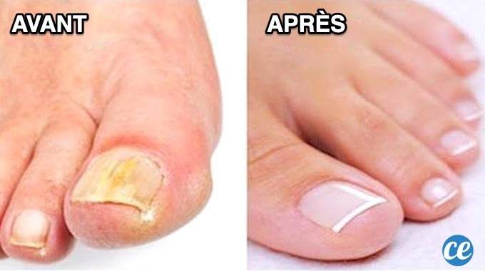 huile antifongique pour ongles